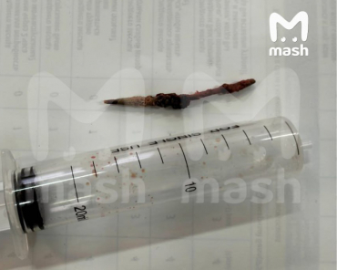 Зубочистку из мочевого пузыря извлекли у пациента в Пушкино